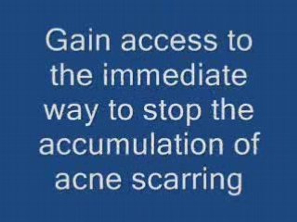 Acne Solutions, Cures, Medications, Treatments, STOP IT!