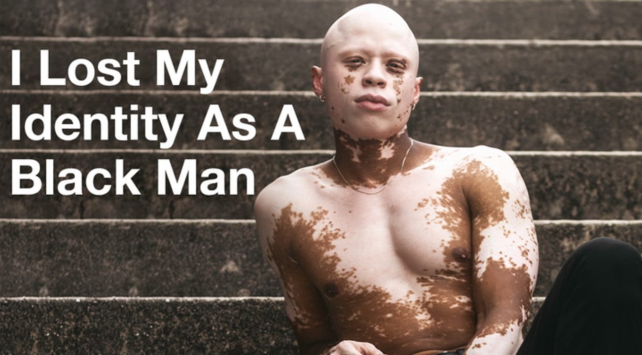 Acne Meds Gave Me Vitiligo - Now I'm Finally Dating | DATING DIFFERENT