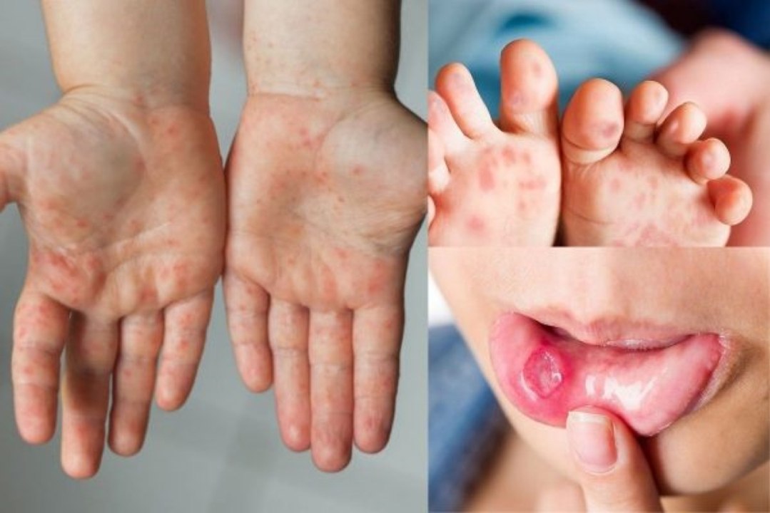 Các bệnh viện tuyến trên sẵn sàng tiếp nhận ca bệnh tay chân miệng nặng