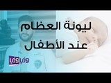 علاج لين العظام عند الأطفال