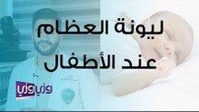 علاج لين العظام عند الأطفال