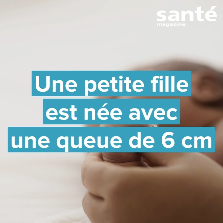 Au Mexique, une petite fille est née avec une queue