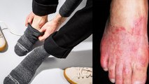 Summer में Full Day Socks पहनने से Fungal Infection से लेकर Edema का खतरा | Boldsky
