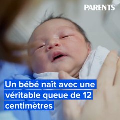 Un bébé naît avec une véritable queue de 12 centimètres