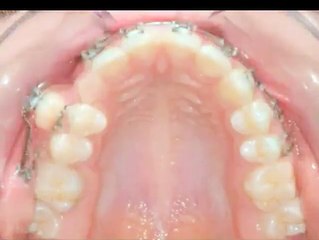 Diş telleri dişleri nasıl düzeltiyor?