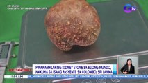 Pinakamalaking kidney stone sa buong mundo, nakuha sa isang pasyente sa Colombo, Sri Lanka | BT
