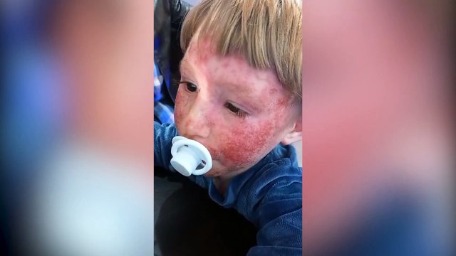 Toddler with extreme eczema seeking donations for life-changing treatment