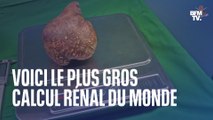801 grammes, 13,37 cm... Le plus gros calcul rénal du monde retiré sur un retraité au Sri Lanka