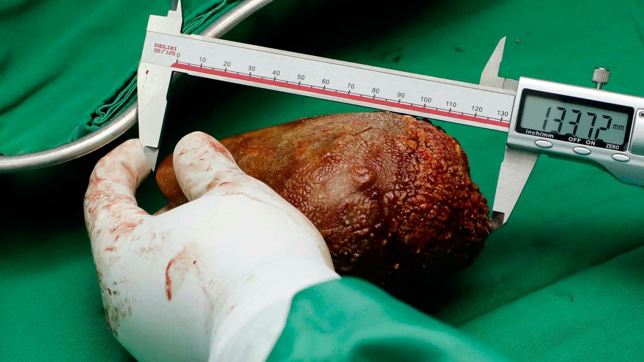 Le plus gros calcul rénal du monde retiré sur un militaire au Sri Lanka