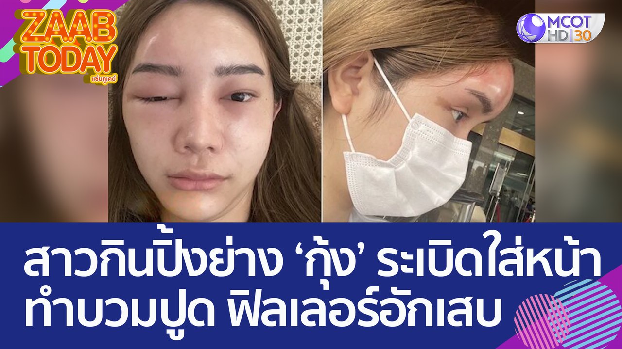 เกือบเสียโฉม! สาวเจอกุ้งระเบิดใส่หน้า - ขณะกินป...