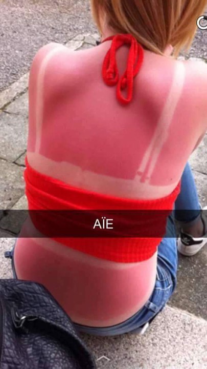 Peut-on vraiment attraper un coup de soleil à l'ombre ?