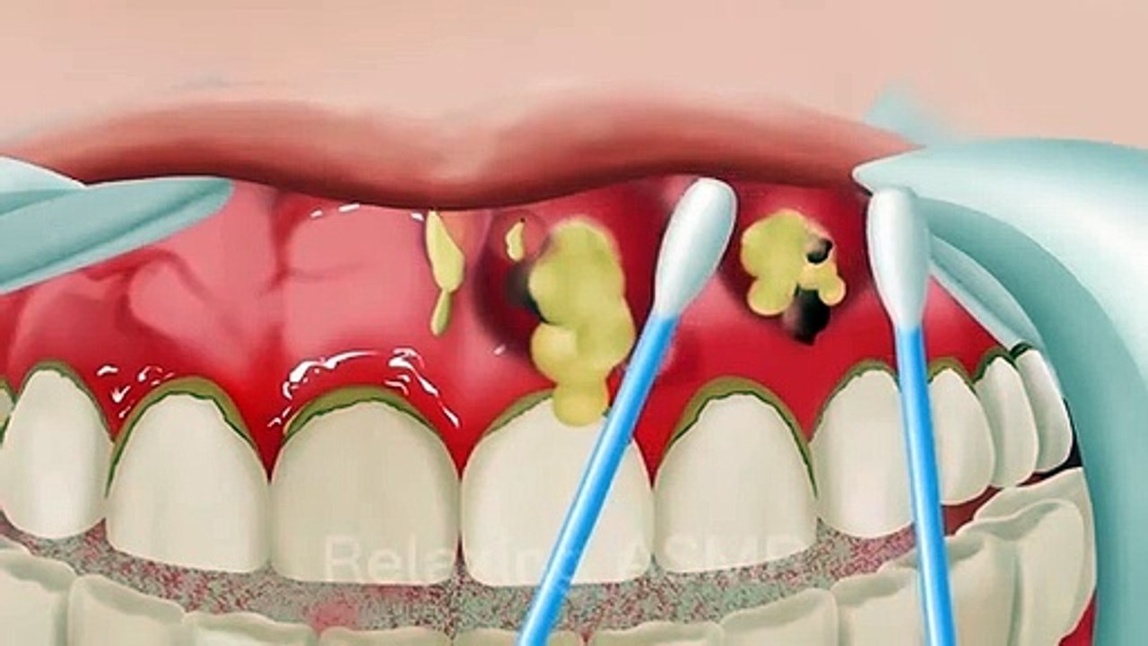 ASMR_The_best_treatment_mouth_blisters,_tonsil_stones,_swollen_gums