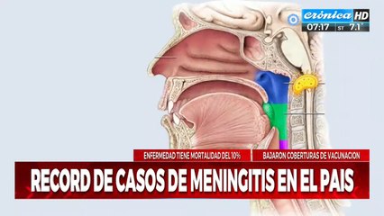 Preocupación por el aumento de casos de meningitis en el país