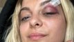 Bebe Rexha updates fans after getting hit in the face by phone during concert