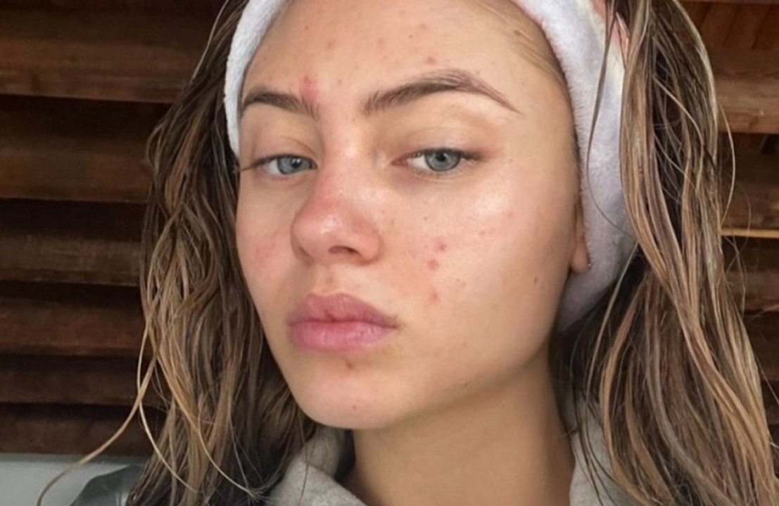 Leni Klum: Auch Models haben Pickel