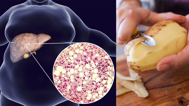 फैटी लिवर में आलू खाना चाहिए कि नहीं | Fatty Liver Me Aalu Khana Chahiye Ki Nahi | Boldsky