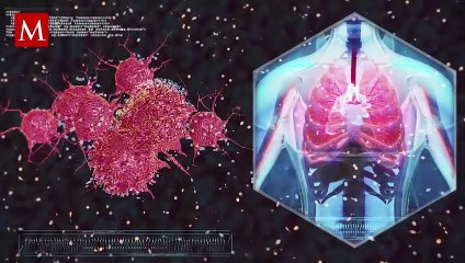 Hombre acude al hospital por un dolor de pecho y encuentran una rama de abeto en su pulmón