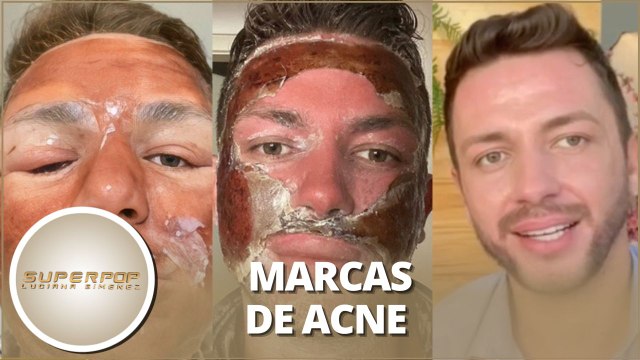 Peeling de Fenol: conheça o procedimento que viralizou nas redes sociais