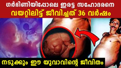 ഇരട്ട സഹോദരനെ വയറ്റിലിട്ട് ജീവിച്ചത് 36 വര്‍ഷം.ഞെട്ടിക്കും ഈ യുവാവിന്റെ ജീവിതം
