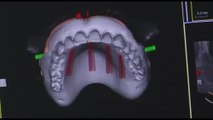 Implantologia dentale computer guidata: ultima frontiera odontoiatria