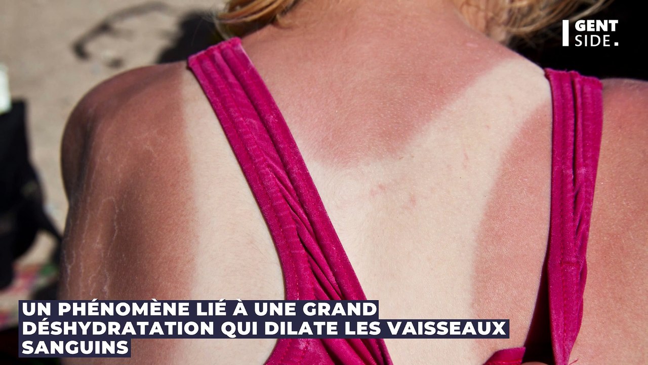 Elle s’endort sur la plage pendant 5 heures et se réveille avec "un visage de tortue"