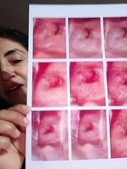 TESTIMONIO SANACION CANCER CERVIX