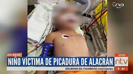 Niño víctima de picadura de alacrán