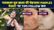 पावसामुळे चेहऱ्यावर Pimples येतात? लगेचच 'हे' उपाय करा | How to Get Rid of Pimples Lokmat Sakhi MA3