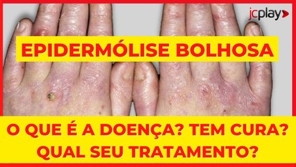 EPIDERMÓLISE BOLHOSA: O QUE É A DOENÇA? TEM CURA? QUAL SEU TRATAMENTO?