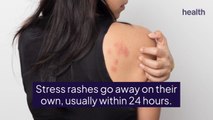 Stress Rashes and Stress Hives—Here's What To Know