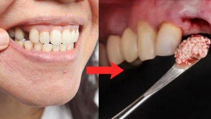 कम उम्र में दांत टूटने की वजह | दांत जल्दी टूट जाते हैं क्यों | दांत किसकी कमी से टूटते है | Boldsky