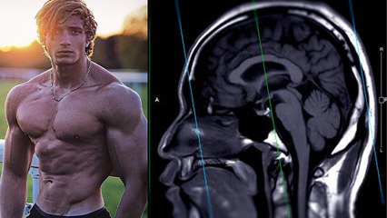 Jo Lindner 30 Age में Demise,  क्या है Aneurysm Symptoms, Reason चौकाने वाला | Boldsky