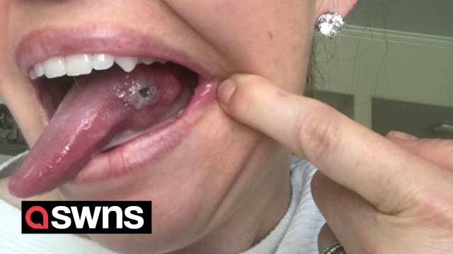 I can never French kiss my husband again after having half of my tongue removed
