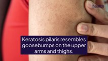 How Is Keratosis Pilaris Treated?