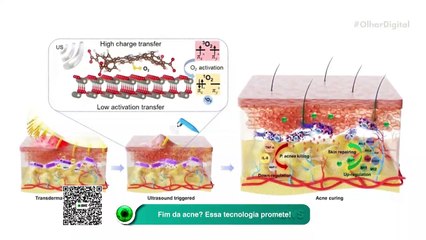 Fim da acne Essa tecnologia promete!