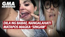 Dila ng babae, nangalahati matapos magka-“singaw” | GMA News Feed