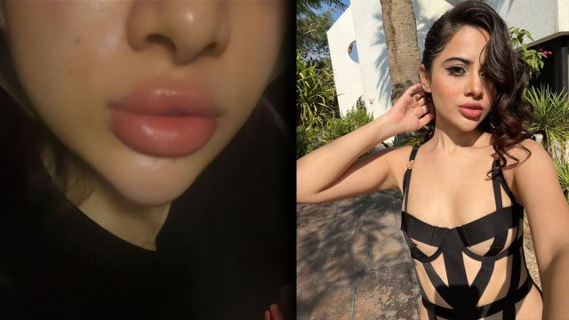 Urfi aka Uorfi Javed ने खूबसूरत दिखने के चक्कर में बिगाड़ा अपना चेहरा, किया कुछ ऐसा...सूज गए Lips