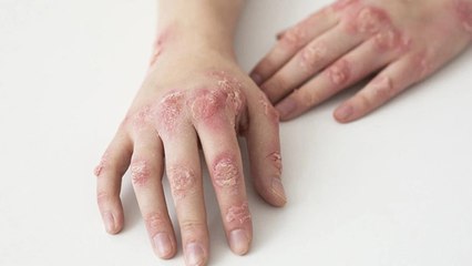 दाद फैलता है क्या । दाद बार-बार क्यों होता है । Daad Failta Hai Kya । Boldsky