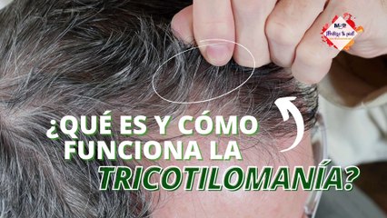 ¿Qué es la #tricotilomanía y cómo funciona con la alopecia? - #ExclusivoMSP