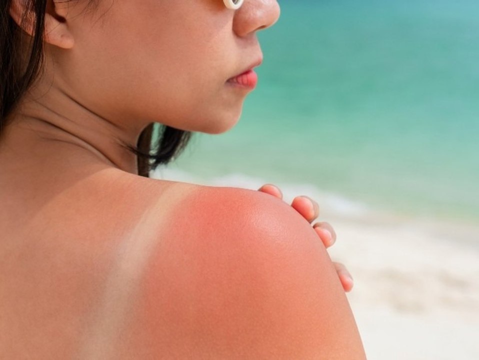 Hausmittel oder Salben? Das hilft wirklich bei Sonnenbrand