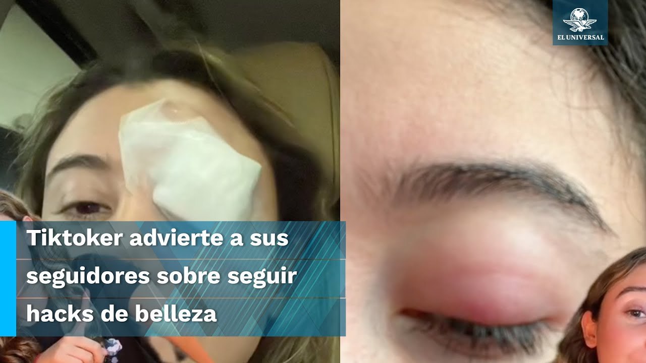 Termina en el quirófano por probar un truco de belleza