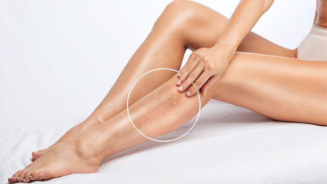 bd-cuando-y-por-que-tratar-las-venas-110723