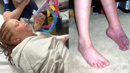 Australian Girl Bella Macey Complex Regional Pain Syndrome से ग्रसित, Symptoms करेंगे दंग