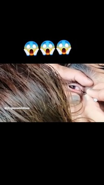 Manipur Doctor, Manipur Video, Manipur Market Video, Aankh me Gaya jok, Eye Problem,Eye Problem Video, Eye Problem Slove, Eye News Video, Eye Video,Eye News Viral, Eye
