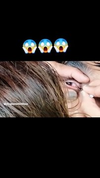 Manipur Doctor, Manipur Video, Manipur Market Video, Aankh me Gaya jok, Eye Problem,Eye Problem Video, Eye Problem Slove, Eye News Video, Eye Video,Eye News Viral, Eye