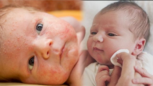 Baby Face Acne Treatment | Baby Face Pimple Removal Tips | बच्चे के चेहरे पर दाने कैसे हटाएं|Boldsky