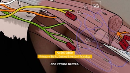 New bionic hand allows users to control each finger with unprecedented accuracy