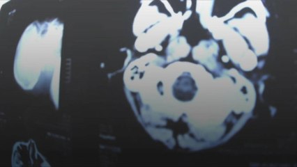 Maladie d'Alzheimer : découverte d'un médicament très prometteur
