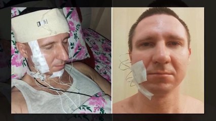 Rusya'da bir adam, rüyalarını kontrol edebilmek için kafasını matkapla deldi