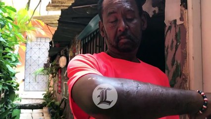 “Dios me protegió" dice enfermo de cáncer tras ser atacado de perro pitbull cerca de su casa